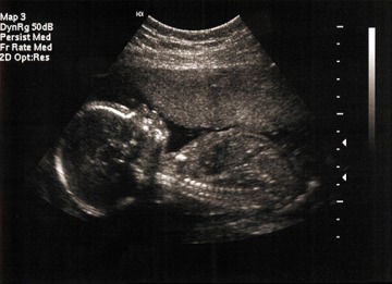 5-month fetus in womb as imaged by sonogram / ultrasound